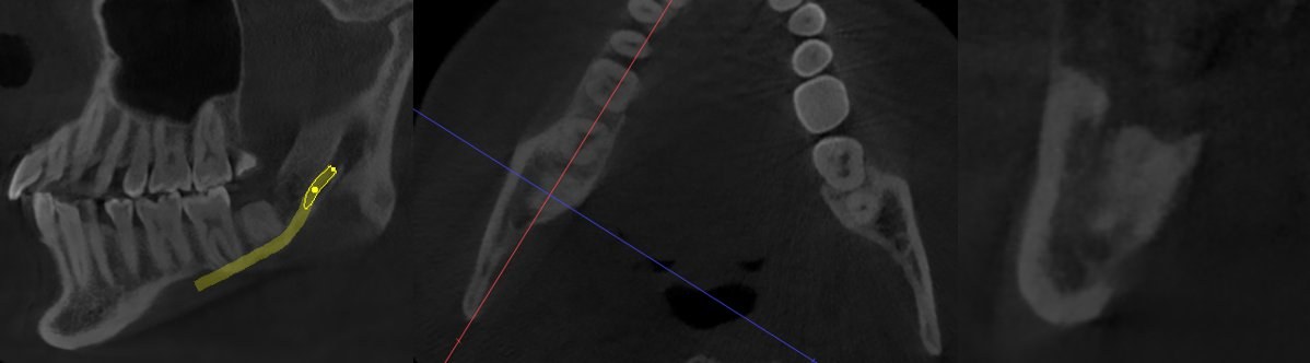 Planificación tomográfica con localización del nervio dentario